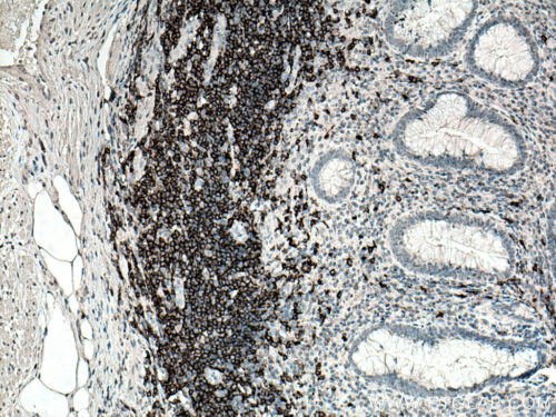 Leukemia CD20 Antibody